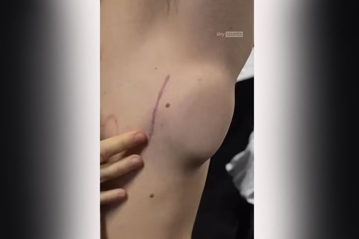 Tom Lockyer has revealed where the Implanted Cardiac Device – VİDEO - PHOTO