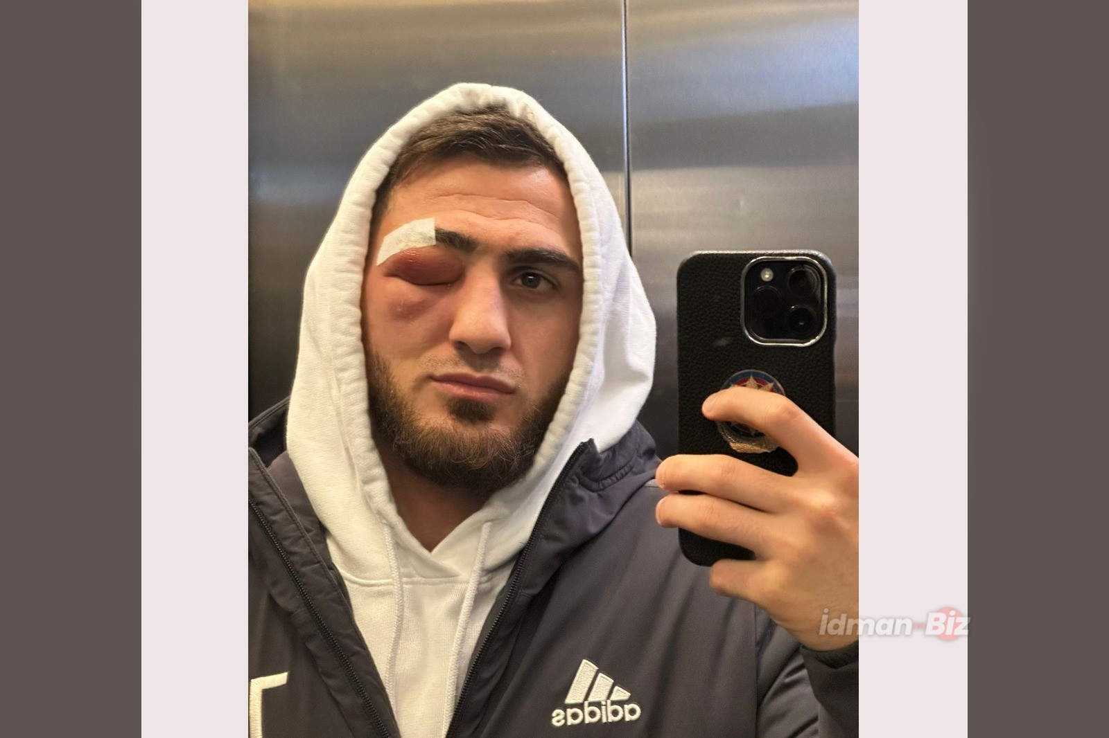 Haji Aliyev’s eye get infected, his face is swollen