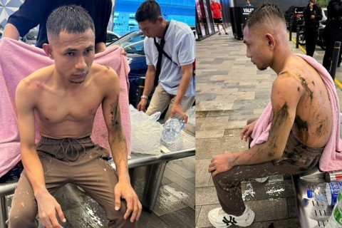 Malaysian footballer burned in acid attack – PHOTO