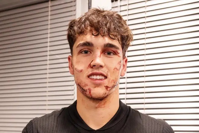 Injury Update on Pau Cubarsi - 10 stitches on face - VIDEO