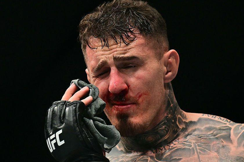 Tom Aspinallın ciddi göz zədəsi təsdiqləndi